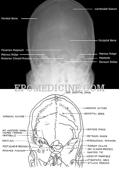 X-ray of Mastoids | Epomedicine