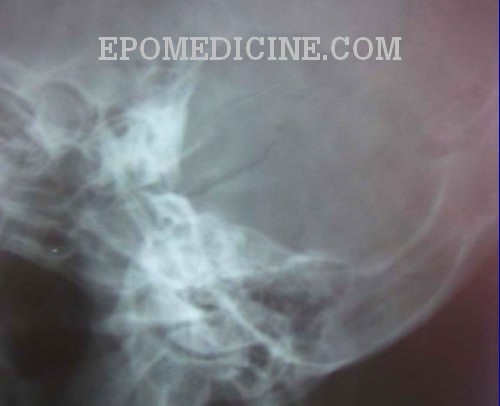 X-ray of Mastoids | Epomedicine