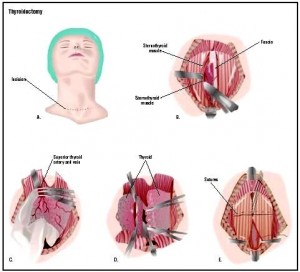 thyroidectomy thyroid partial epomedicine tiroide basics removal subtotal complications chirurgia lobectomy drains isthmus lucchi andrea