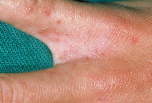 Herpes zoster (shingles) on the hand: MedlinePlus Medical ...