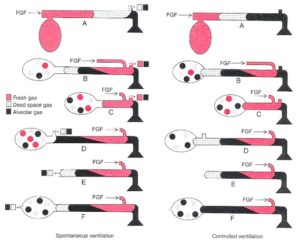 Mapleson Breathing Circuit Made Easy | Epomedicine