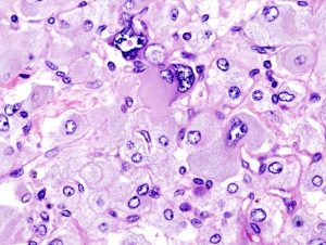 Pheochromocytoma Mnemonics Epomedicine