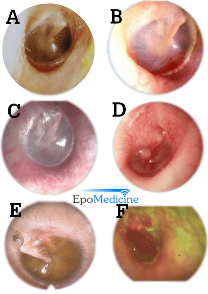 normal tympanic membrane