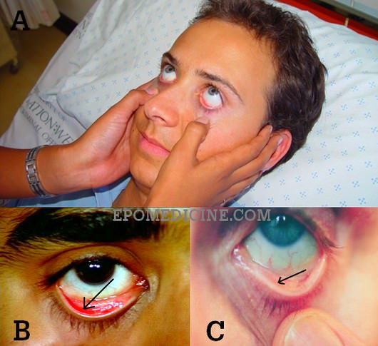 pale conjunctiva