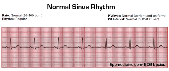 Basics Of Ecg Interpretation Of Waves And Intervals Epomedicine