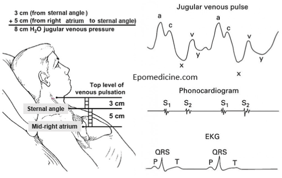 jugular venous pressure