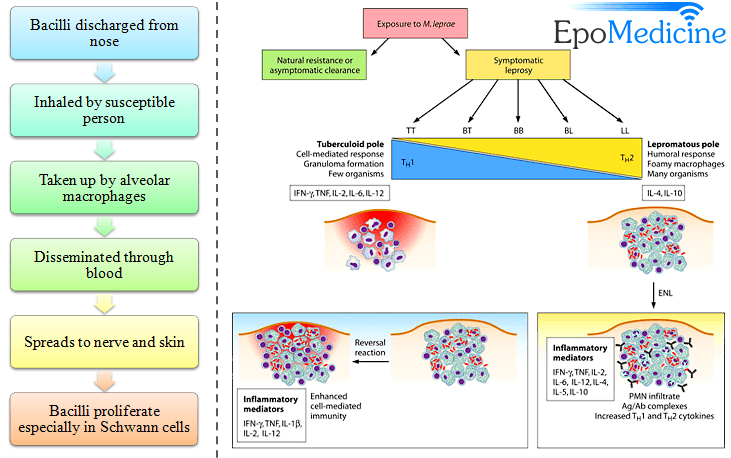 leprosy diagram