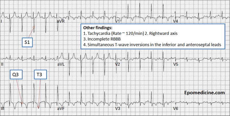 Pulmonary Embolism Ecg