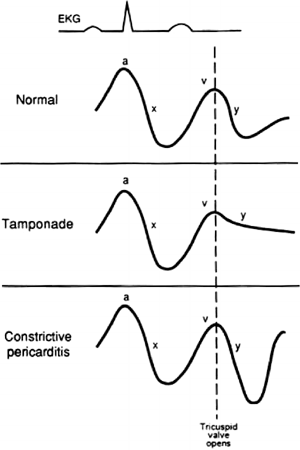 jvp pericarditis tamponade