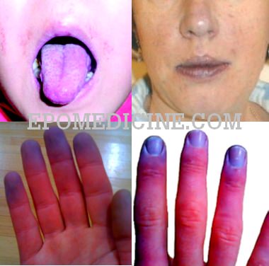 peripheral cyanosis vs central cyanosis