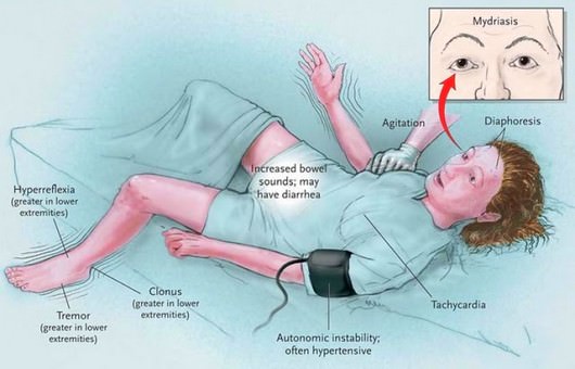 neuroleptic malignant syndrome pathophysiology