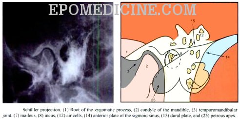 mastoid air cells x ray