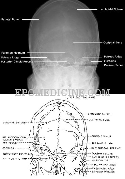 X Ray Of Mastoids Epomedicine