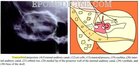 X Ray Of Mastoids Epomedicine