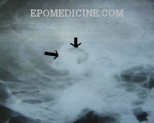 X Ray Of Mastoids Epomedicine