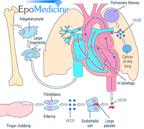 Digital Clubbing Epomedicine