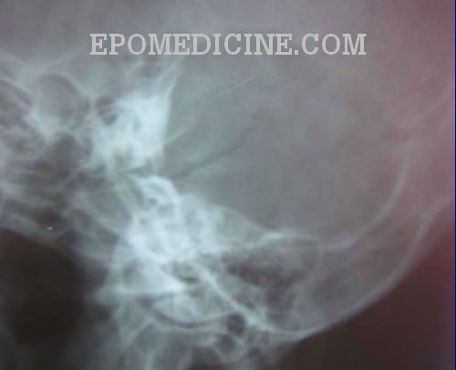 X Ray Of Mastoids Epomedicine