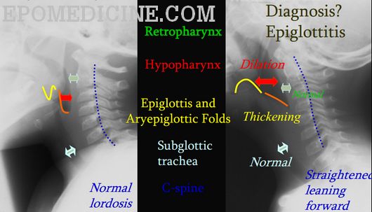 thumb sign epiglottitis