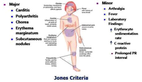 Jones criteria