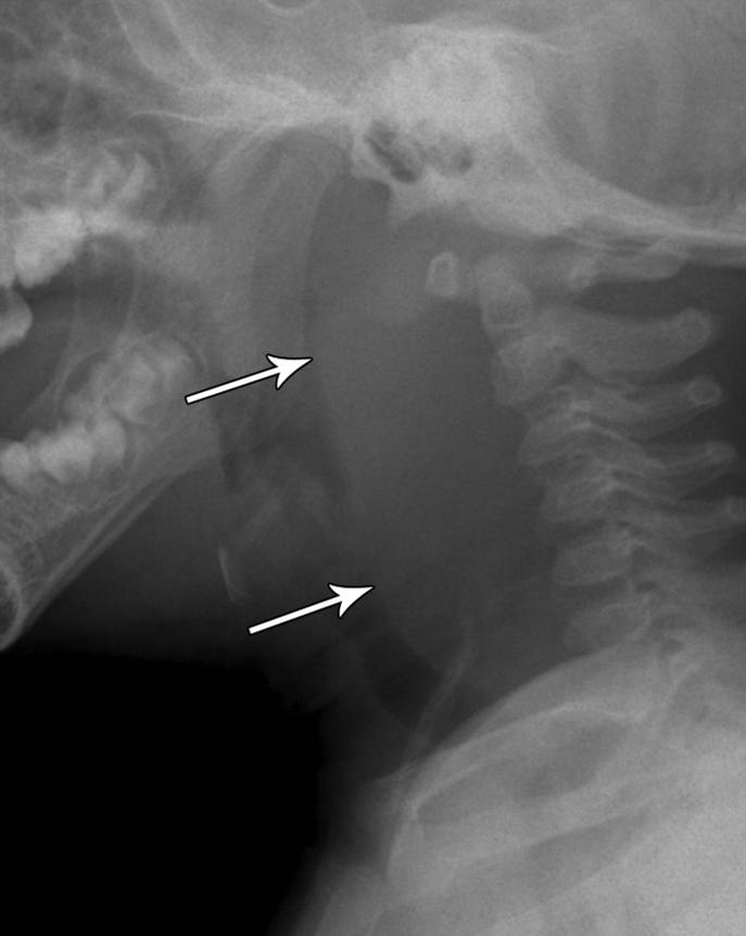 Plain lateral film of the neck showing soft tissue swelling and gas