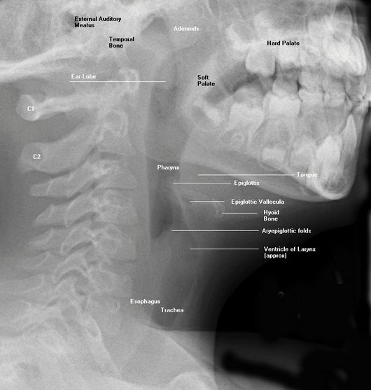 hyoid bone x ray