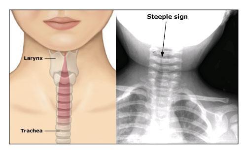 Plain lateral film of the neck showing soft tissue swelling and gas