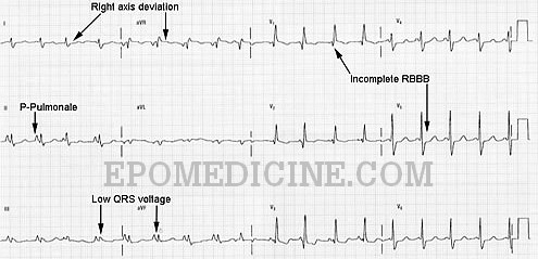 ECG changes in Chronic Obstructive Pulmonary Disease (COPD) | Epomedicine