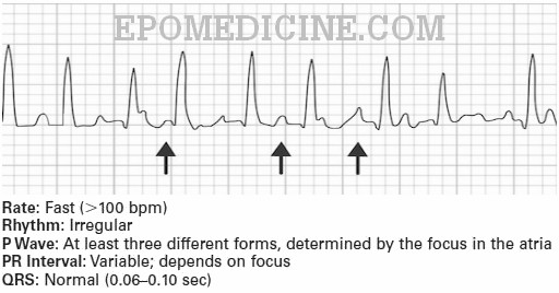 Ecg Changes In Chronic Obstructive Pulmonary Disease Copd