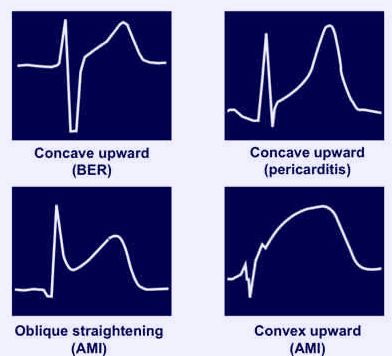 Ecg Changes In Pericarditis Epomedicine