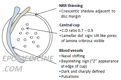 Advanced glaucomatous changes diagram