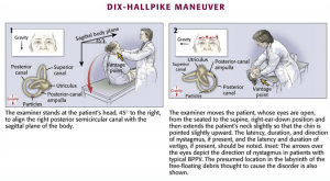 Vestibular examination : Dix-Hallpike Maneuver for BPPV | Epomedicine