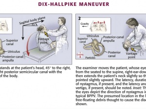 Dix hallpike maneuver