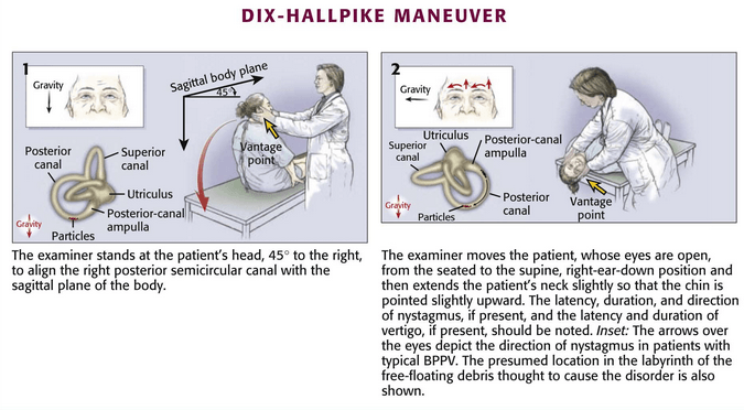 Dix hallpike maneuver