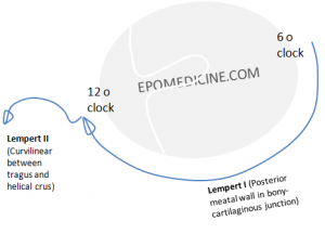 Approaches to Middle ear and Mastoid surgery | Epomedicine