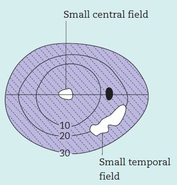 Advance glaucomatous field defect