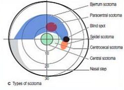 File:Types of scotomas and the location on the retina.png - Wikimedia ...