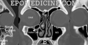 Anatomy of Ostiomeatal complex | Epomedicine