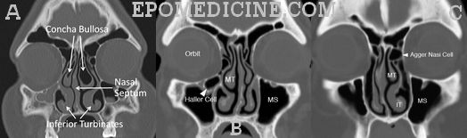 Ostiomeatal unit anatomic variants