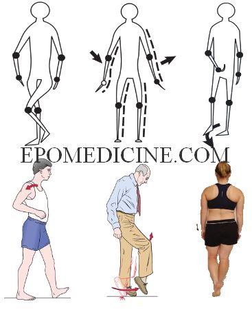 gait abnormalities patterns