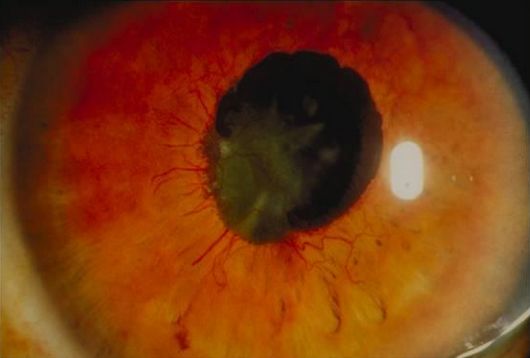 rubeosis iridis neovascular glaucoma