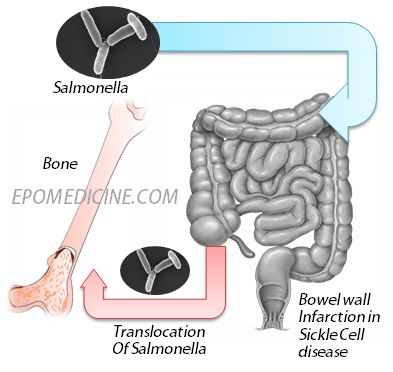 Salmonella Osteomyelitis In Sickle Cell Disease Epomedicine