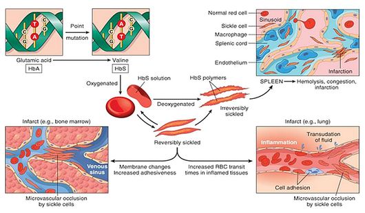 salmonella-osteomyelitis-in-sickle-cell-disease-epomedicine