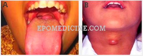 thyroglossal cyst