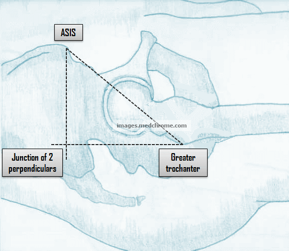 Bryant s Triangle Examination Of Hip Epomedicine Bryant s Triangle Examination Of Hip Epomedicine