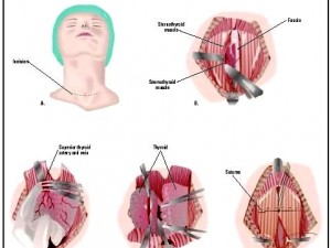 Thyroidectomy procedure