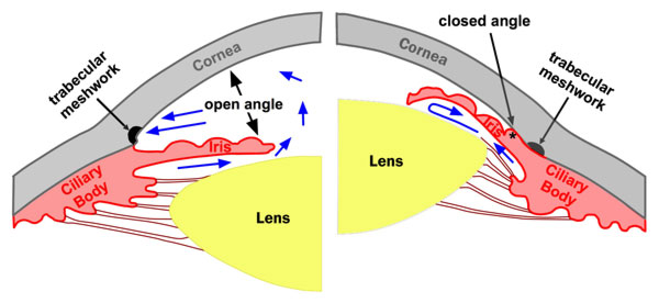 open-closed angle glaucoma