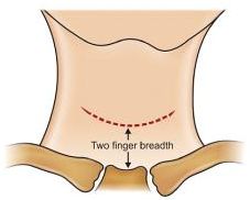 thyroidectomy incision kocher collar thyroid transverse suprasternal notch basics epomedicine breadths sternocleidomastoid finger above another