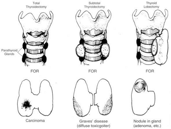 Thyroidectomy Basics | Epomedicine