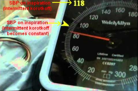 Pulsus paradoxus measurement clinical