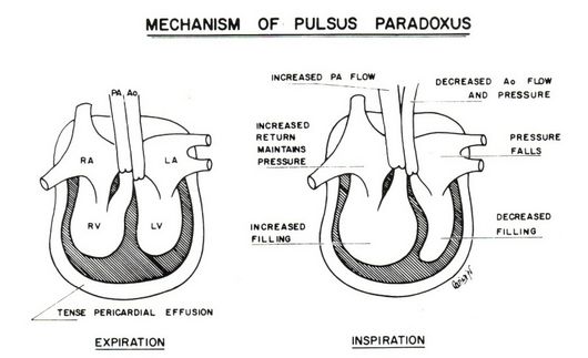 pulsus paradoxus pericardial effusin